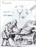Surgical operation to amputate a leg (engraving) (b/w photo)